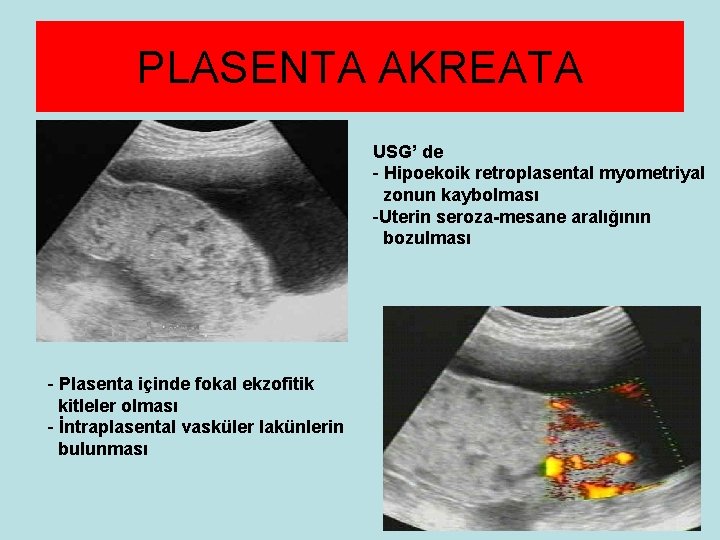 PLASENTA AKREATA USG’ de - Hipoekoik retroplasental myometriyal zonun kaybolması -Uterin seroza-mesane aralığının bozulması