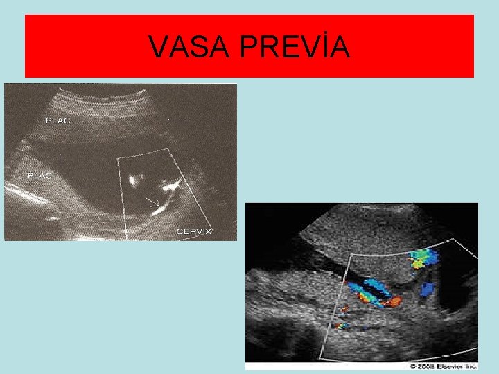 VASA PREVİA 