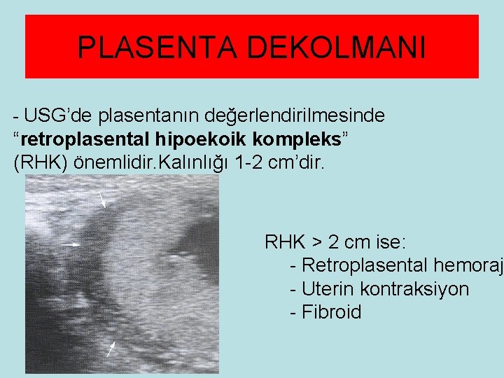 PLASENTA DEKOLMANI - USG’de plasentanın değerlendirilmesinde “retroplasental hipoekoik kompleks” (RHK) önemlidir. Kalınlığı 1 -2