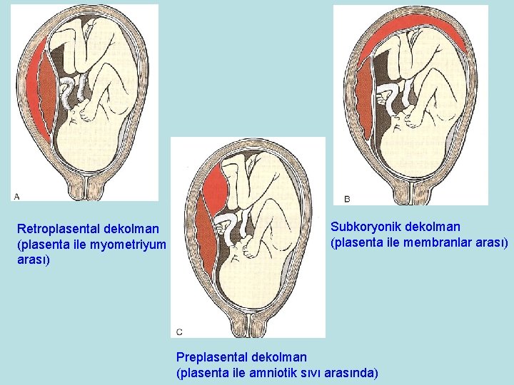 Retroplasental dekolman (plasenta ile myometriyum arası) Subkoryonik dekolman (plasenta ile membranlar arası) Preplasental dekolman