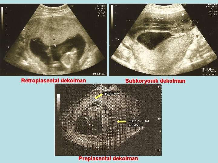 Retroplasental dekolman Subkoryonik dekolman Preplasental dekolman 