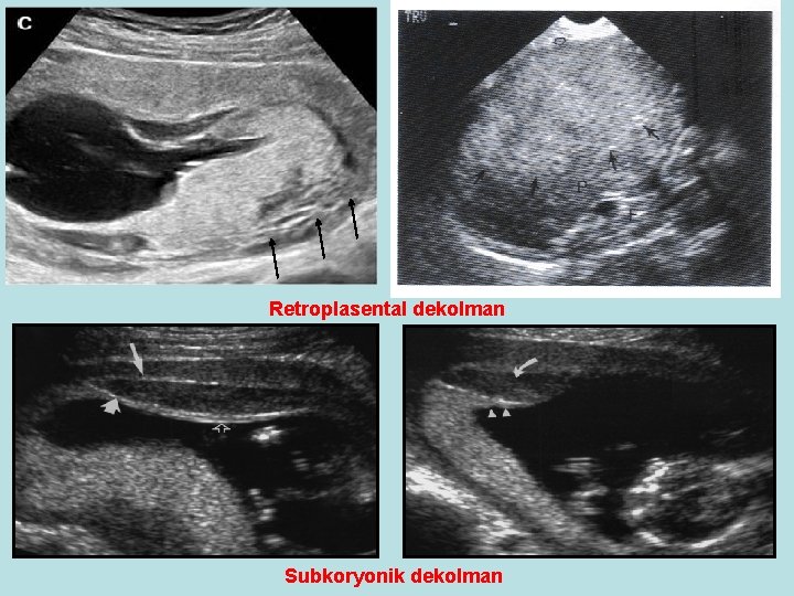 Retroplasental dekolman Subkoryonik dekolman Retroplasental dekolman Subkoryonik dekolman