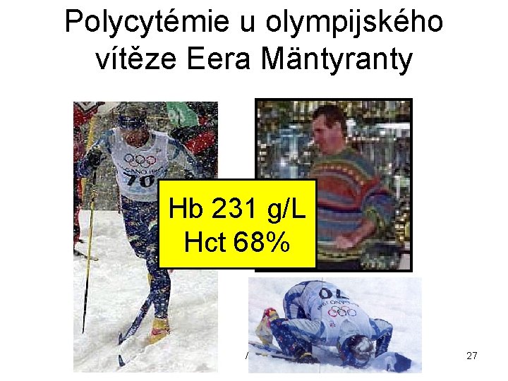 Polycytémie u olympijského vítěze Eera Mäntyranty Hb 231 g/L Hct 68% / 50 27