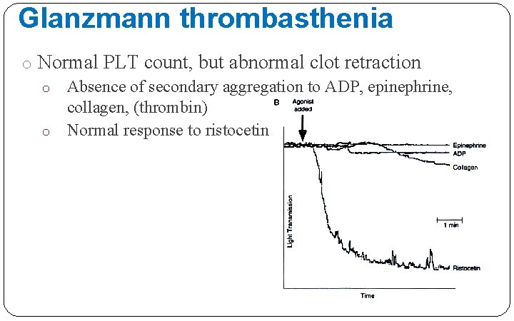 Glanzmann thrombasthenia o Normal PLT count, but abnormal clot retraction o Absence of secondary