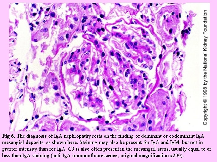  Fig 6. The diagnosis of Ig. A nephropathy rests on the finding of