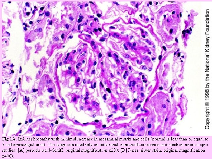  Fig 1 A. Ig. A nephropathy with minimal increase in mesangial matrix and