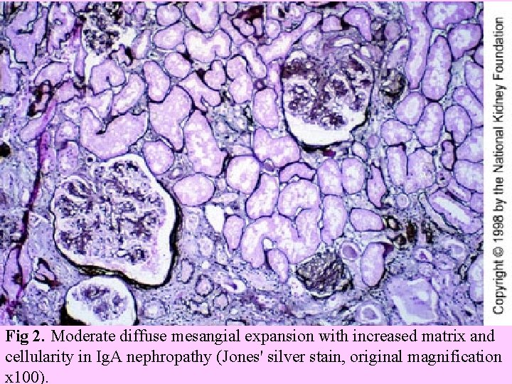  Fig 2. Moderate diffuse mesangial expansion with increased matrix and cellularity in Ig.