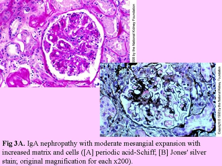  Fig 3 A. Ig. A nephropathy with moderate mesangial expansion with increased matrix