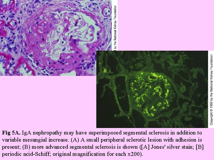  Fig 5 A. Ig. A nephropathy may have superimposed segmental sclerosis in addition