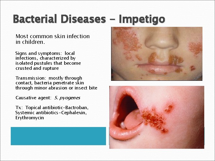 Bacterial Diseases - Impetigo Most common skin infection in children. Signs and symptoms: local