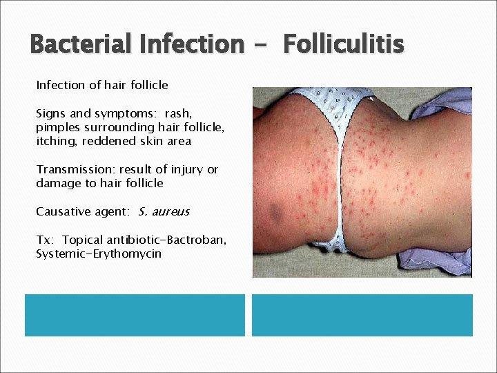 Bacterial Infection - Folliculitis Infection of hair follicle Signs and symptoms: rash, pimples surrounding