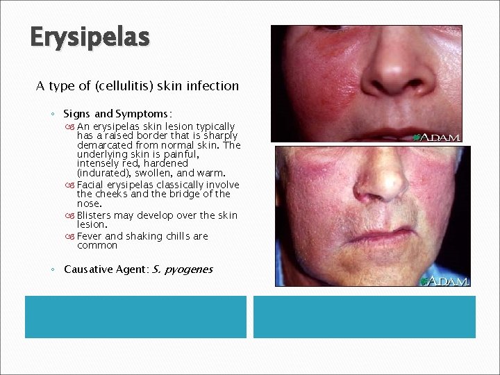 Erysipelas A type of (cellulitis) skin infection ◦ Signs and Symptoms: An erysipelas skin