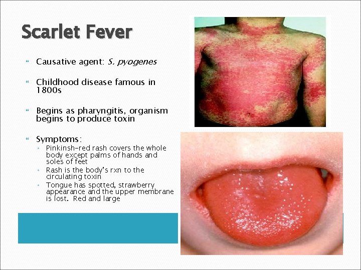 Scarlet Fever Causative agent: S. pyogenes Childhood disease famous in 1800 s Begins as