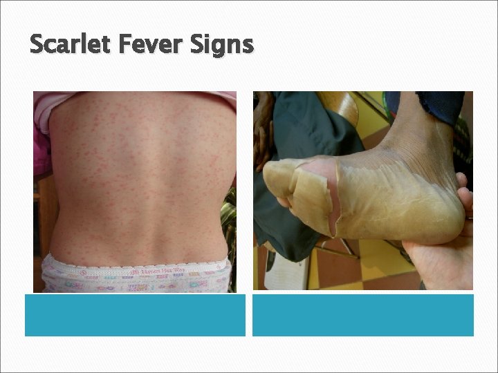 Scarlet Fever Signs 