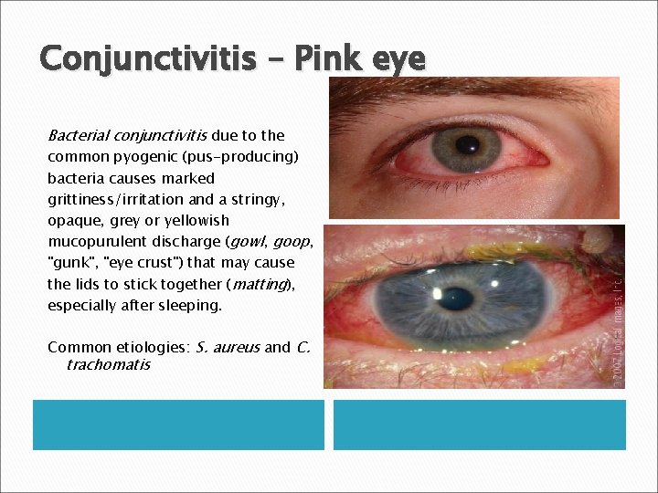 Conjunctivitis – Pink eye Bacterial conjunctivitis due to the common pyogenic (pus-producing) bacteria causes