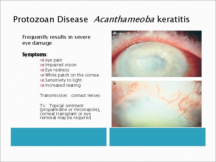 Protozoan Disease Acanthameoba keratitis Frequently results in severe eye damage Symptoms: eye pain Impaired