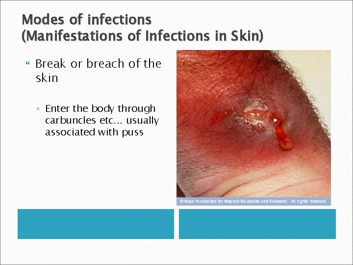 Modes of infections (Manifestations of Infections in Skin) Break or breach of the skin