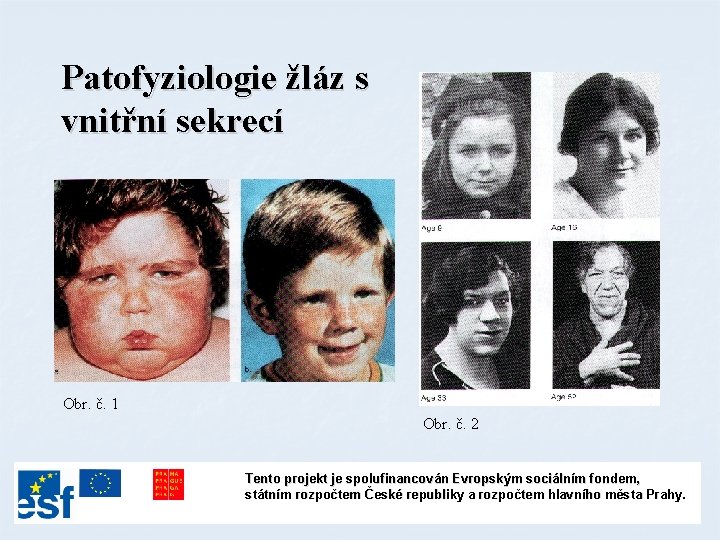 Patofyziologie žláz s vnitřní sekrecí Obr. č. 1 Obr. č. 2 Tento projekt je