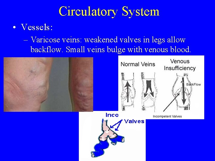 Circulatory System • Vessels: – Varicose veins: weakened valves in legs allow backflow. Small