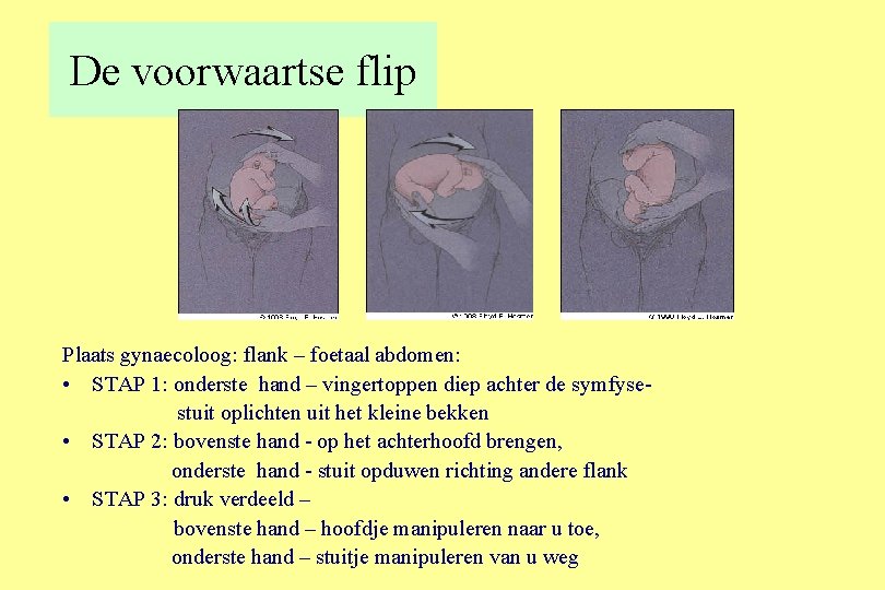 De voorwaartse flip Plaats gynaecoloog: flank – foetaal abdomen: • STAP 1: onderste hand