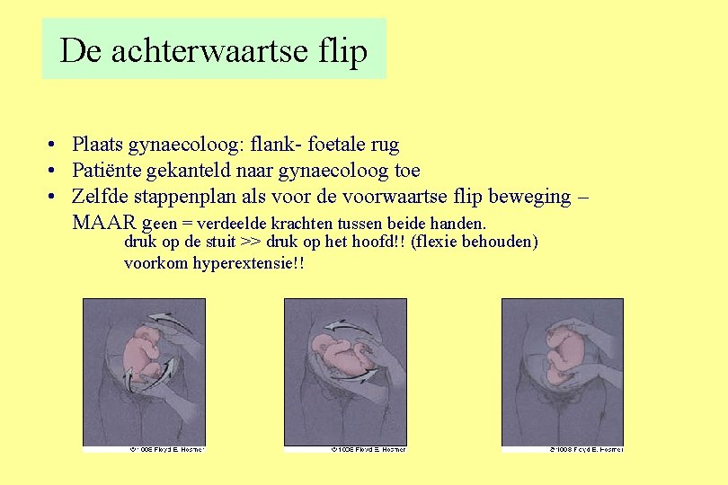 De achterwaartse flip • Plaats gynaecoloog: flank- foetale rug • Patiënte gekanteld naar gynaecoloog