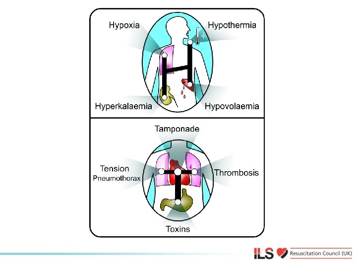 Reversible causes 