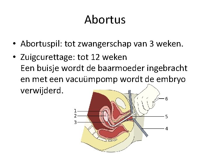 Abortus • Abortuspil: tot zwangerschap van 3 weken. • Zuigcurettage: tot 12 weken Een