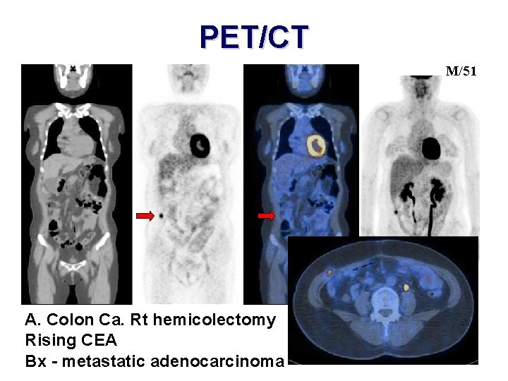 PET/CT M/51 A. Colon Ca. Rt hemicolectomy Rising CEA Bx - metastatic adenocarcinoma 