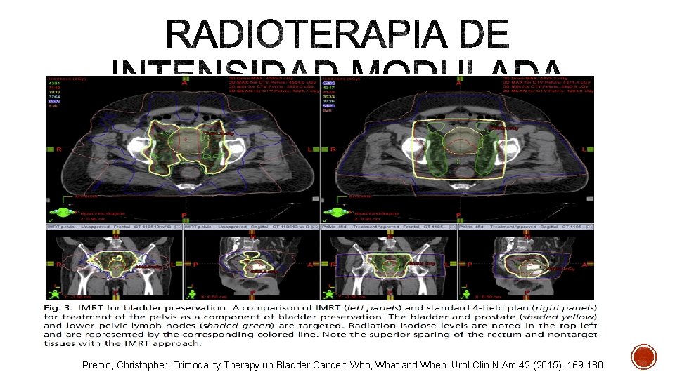Premo, Christopher. Trimodality Therapy un Bladder Cancer: Who, What and When. Urol Clin N