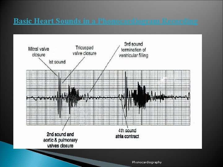 Basic Heart Sounds in a Phonocardiogram Recording Phonocardiography 