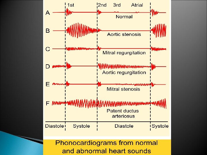 Phonocardiography 