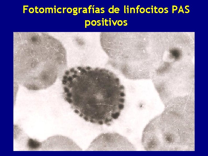 Fotomicrografías de linfocitos PAS positivos 