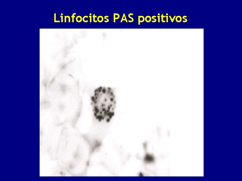 Linfocitos PAS positivos 