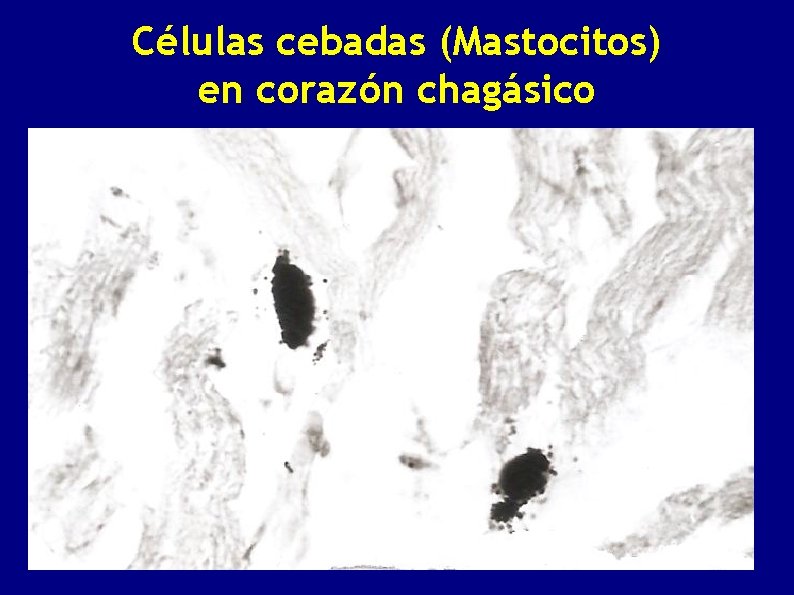 Células cebadas (Mastocitos) en corazón chagásico 