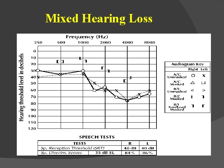 Mixed Hearing Loss 