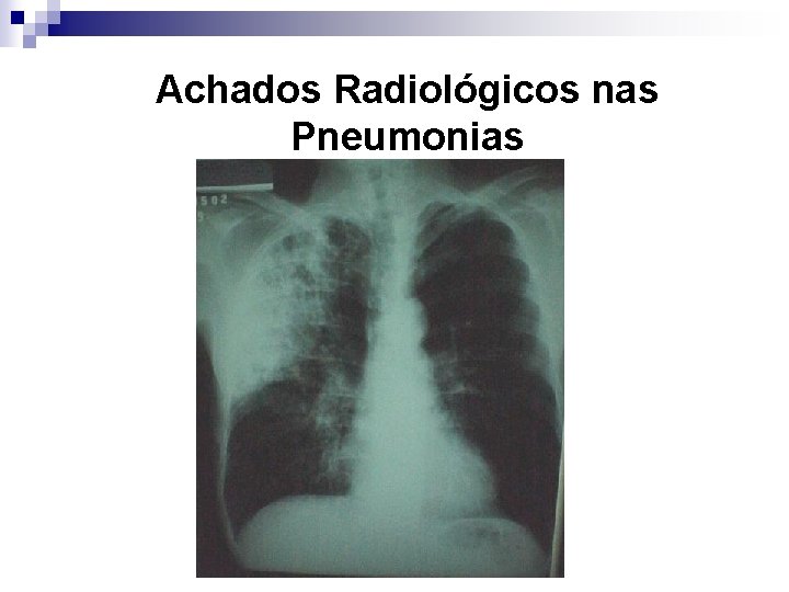 Achados Radiológicos nas Pneumonias 