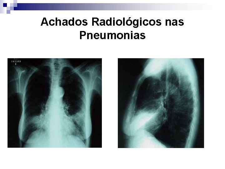 Achados Radiológicos nas Pneumonias 