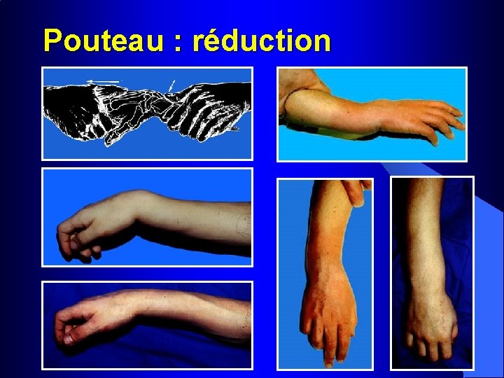 Pouteau : réduction 