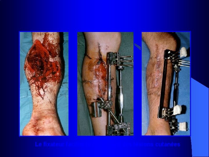 Le fixateur facilite le traitement des lésions cutanées 