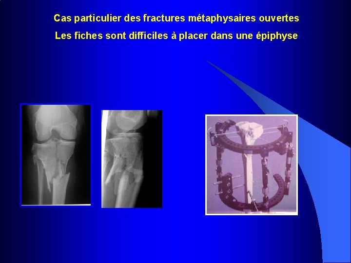 Cas particulier des fractures métaphysaires ouvertes Les fiches sont difficiles à placer dans une