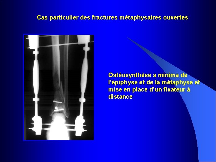 Cas particulier des fractures métaphysaires ouvertes Ostéosynthèse a minima de l’épiphyse et de la