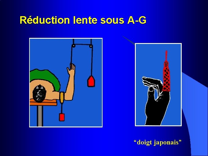 Réduction lente sous A-G “doigt japonais” 