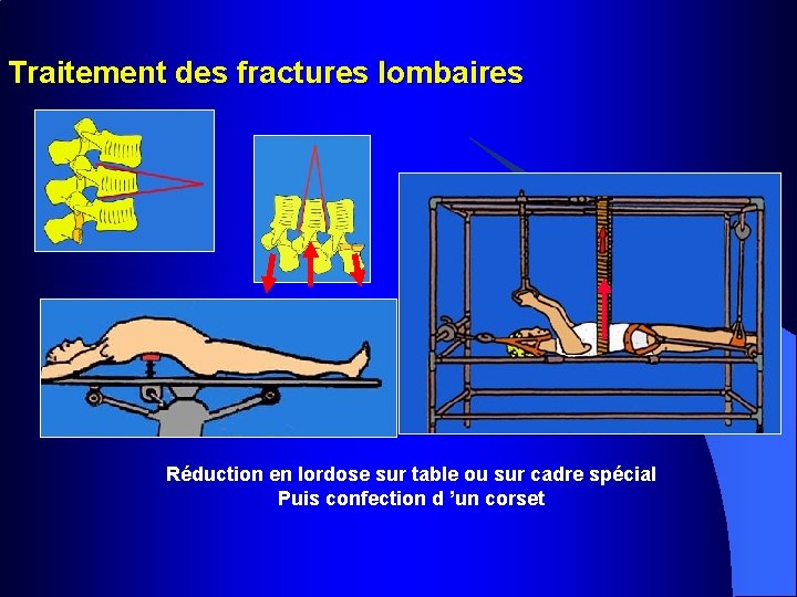 Traitement des fractures lombaires Réduction en lordose sur table ou sur cadre spécial Puis