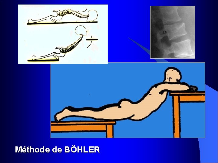 Méthode de BÖHLER 