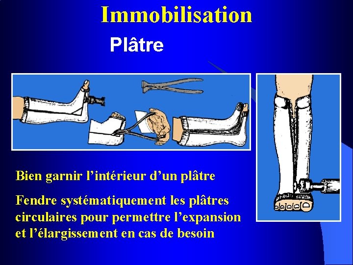 Immobilisation Plâtre Bien garnir l’intérieur d’un plâtre Fendre systématiquement les plâtres circulaires pour permettre