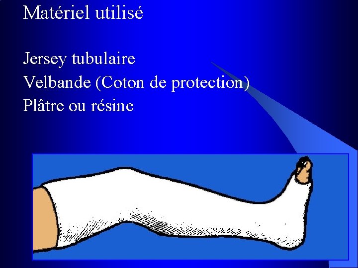 Matériel utilisé Jersey tubulaire Velbande (Coton de protection) Plâtre ou résine 