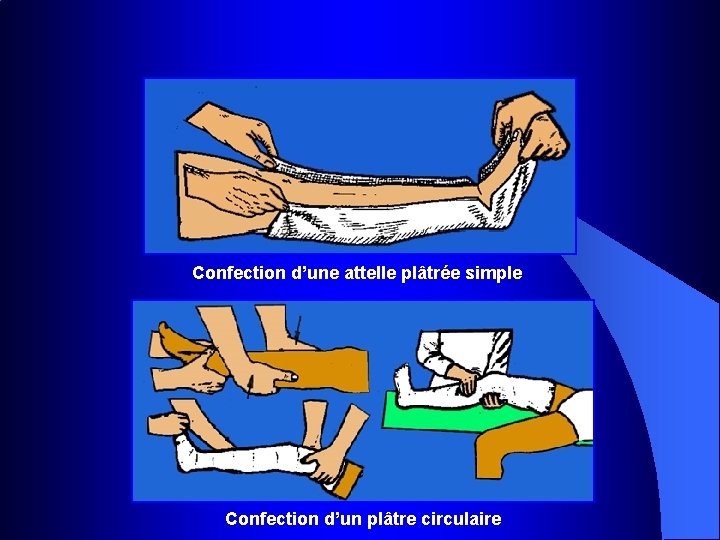 Confection d’une attelle plâtrée simple Confection d’un plâtre circulaire 