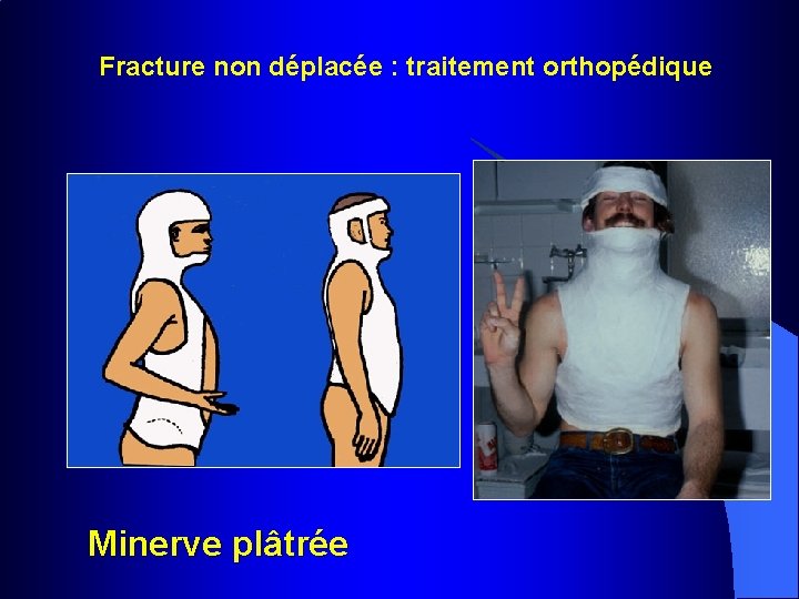 Fracture non déplacée : traitement orthopédique Minerve plâtrée 