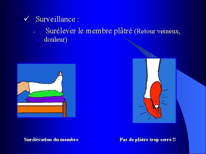 ü Surveillance : • Surélever le membre plâtré (Retour veineux, douleur) Surélévation du membre