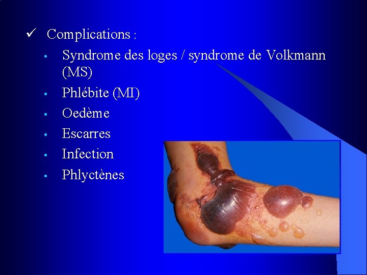 ü Complications : • Syndrome des loges / syndrome de Volkmann (MS) • Phlébite